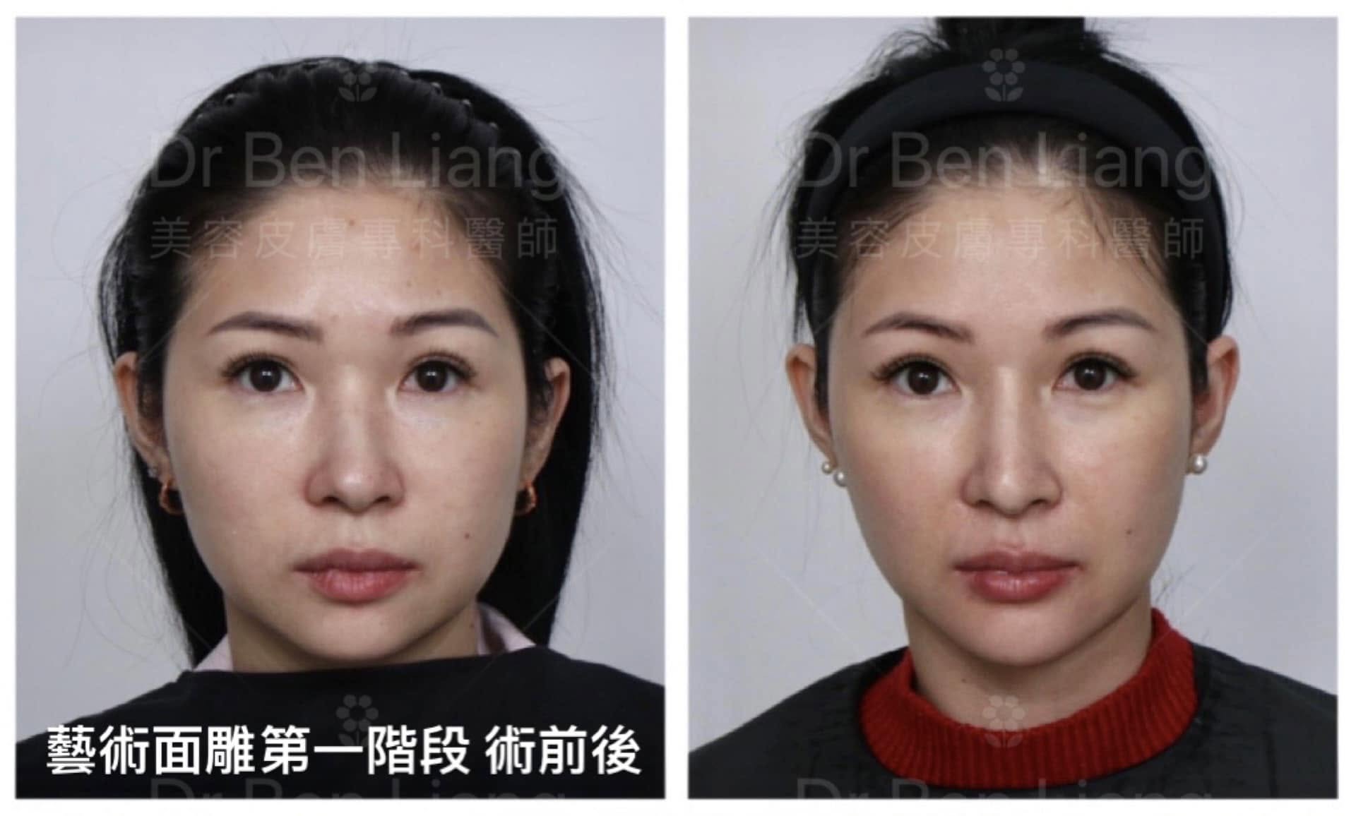 藝術面雕 Plus 第一階段術前後比較